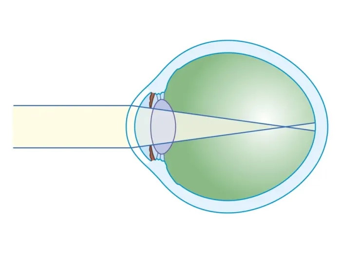 Framed Print : Cross section biomedical illustration of myopia Framed Print : Cross section biomedical illustration of myopia