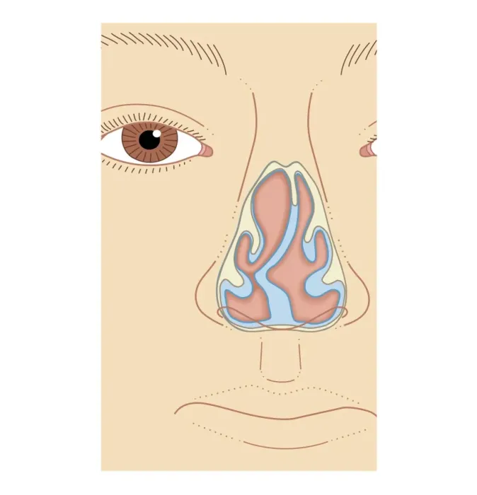 Framed Print : Cross section biomedical illustration of nasal septum deviation, close-up