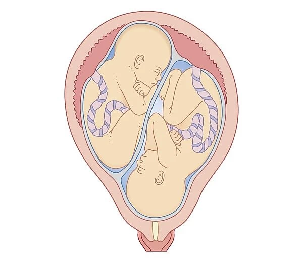 Cross section biomedical illustration of non identical twins in uterus with separate placentas