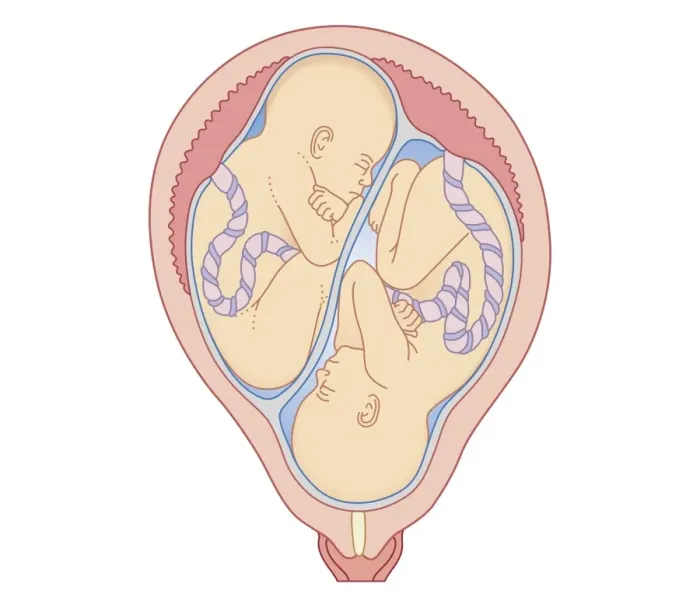 Framed Print : Cross section biomedical illustration of non identical twins in uterus with separate placentas Framed Print : Cross section biomedical illustration of non identical twins in uterus with separate placentas