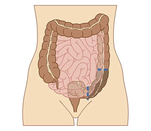 Cross section biomedical illustration of partial colectomy