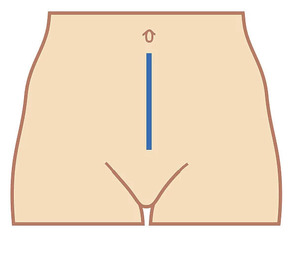 Cross section biomedical illustration of position of colectomy incision
