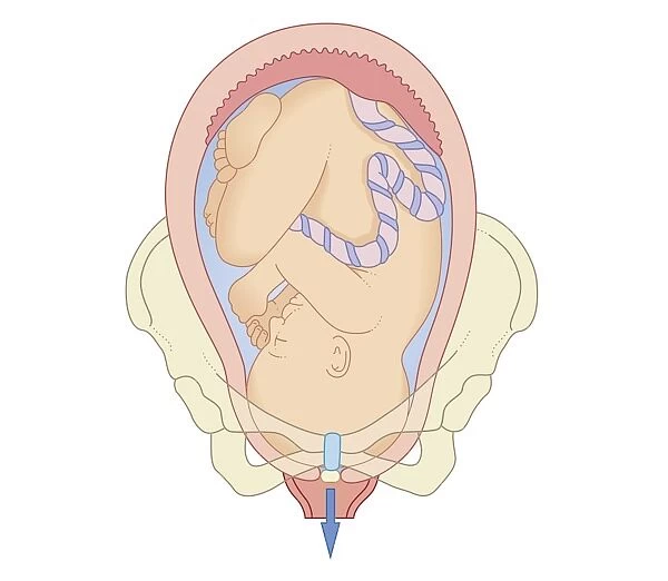 Cross section biomedical illustration of position foetus in pelvis at first stage of labour
