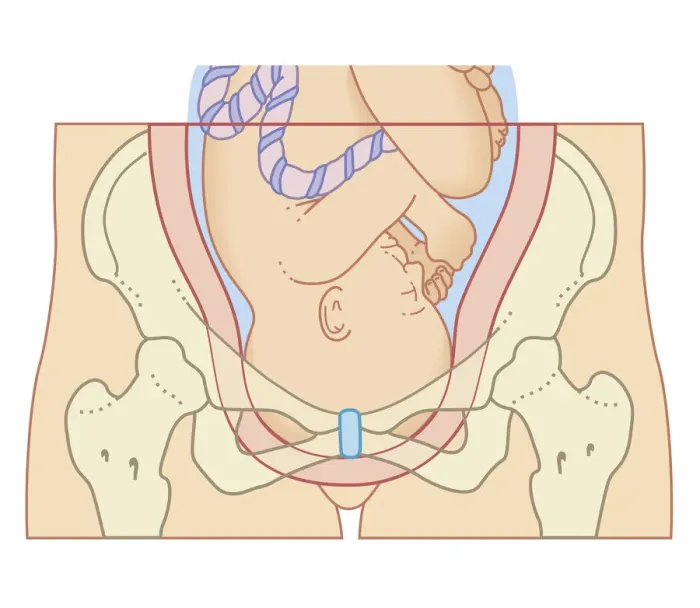 Framed Print : Cross section biomedical illustration of position of foetus in uterus after engagement process Framed Print : Cross section biomedical illustration of position of foetus in uterus after engagement process