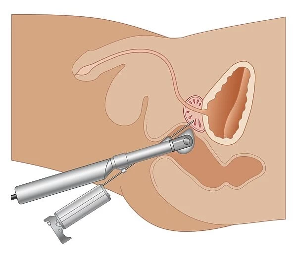 Cross section biomedical illustration of prostate gland needle biopsy procedure