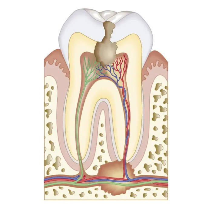 Framed Print : Cross section biomedical illustration of pulp and root abscess in molar Framed Print : Cross section biomedical illustration of pulp and root abscess in molar