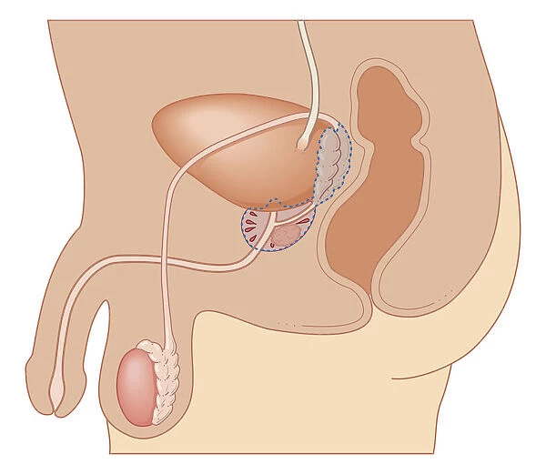 Cross section biomedical illustration of radical prostatectomy procedure