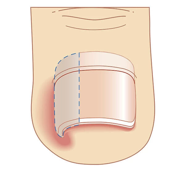 Cross section biomedical illustration of removal site of ingrown toenail (Onychocryptosis)