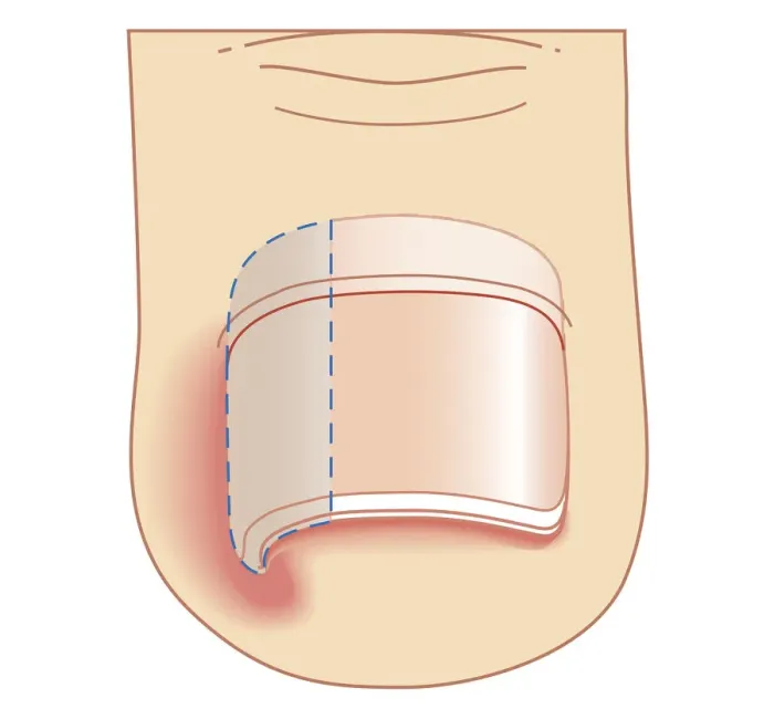 Framed Print : Cross section biomedical illustration of removal site of ingrown toenail (Onychocryptosis)