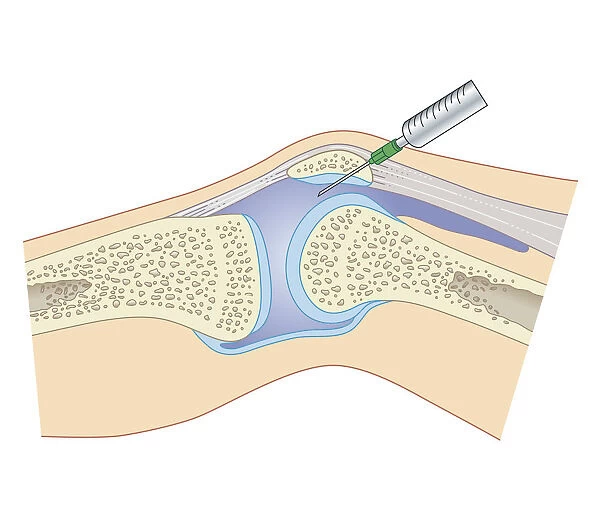 Cross section biomedical illustration of removing synovial fluid from knee using joint aspiration