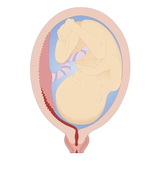 Cross section biomedical illustration of revealed placental abruption