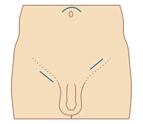 Cross section biomedical illustration of site of incision for hernia repair
