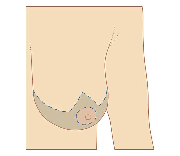 Cross section biomedical illustration of site of breast reduction