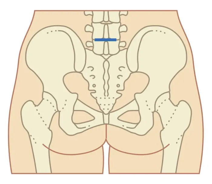 Framed Print : Cross section biomedical illustration of site of incision for microdiscectomy surgical procedure Framed Print : Cross section biomedical illustration of site of incision for microdiscectomy surgical procedure