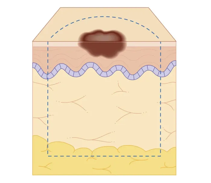 Framed Print : Cross section biomedical illustration of site of skin biopsy