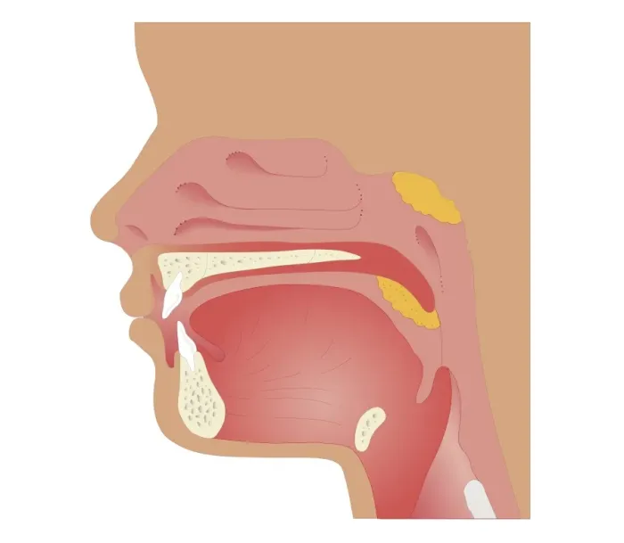 Framed Print : Cross section biomedical illustration of sites of tonsilectomy and adenoidectomy procedures Framed Print : Cross section biomedical illustration of sites of tonsilectomy and adenoidectomy procedures