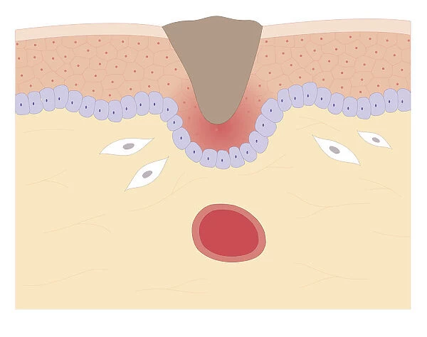 Cross section biomedical illustration of skin repair with fibroblast forming plug within Thrombus (blood clot) which contracts and plug shrinks and new skin tissue forms underneath