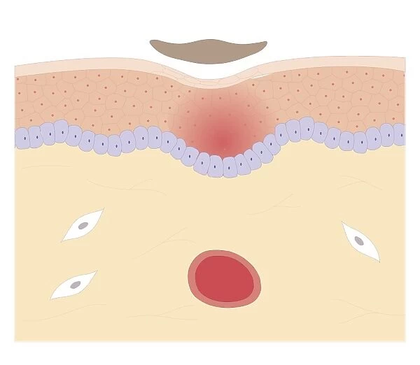 Cross section biomedical illustration of skin repair with fibrous plug hardening to become scab which falls off when new skin growth is complete