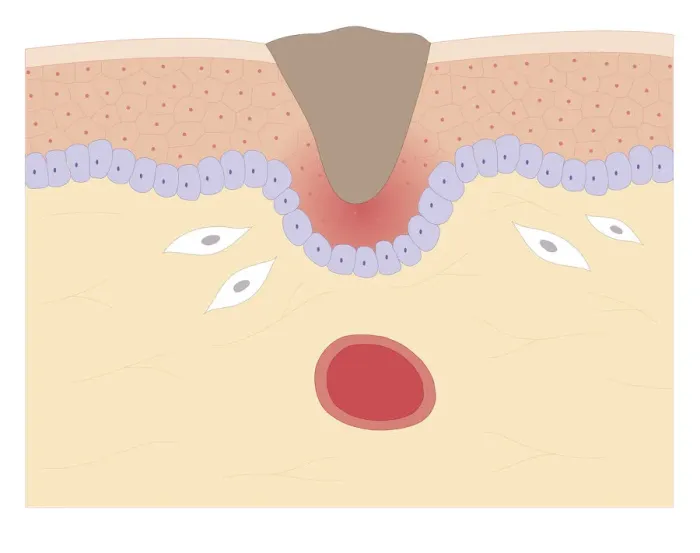 Framed Print : Cross section biomedical illustration of skin repair with fibroblast forming plug within Thrombus (blood clot) which contracts and plug shrinks and new skin tissue forms underneath