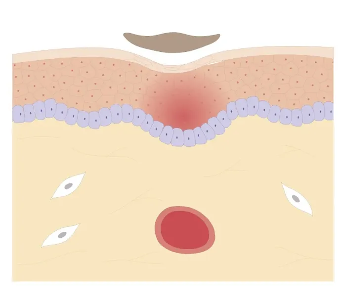Framed Print : Cross section biomedical illustration of skin repair with fibrous plug hardening to become scab which falls off when new skin growth is complete