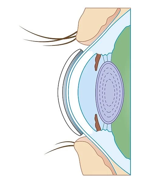 Cross section biomedical illustration of soft contact lens on eye