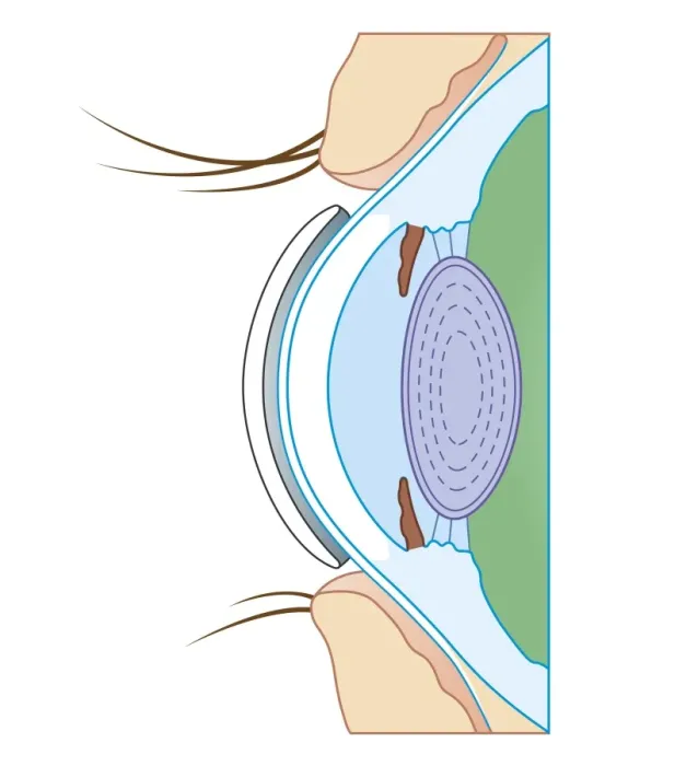 Framed Print : Cross section biomedical illustration of soft contact lens on eye Framed Print : Cross section biomedical illustration of soft contact lens on eye