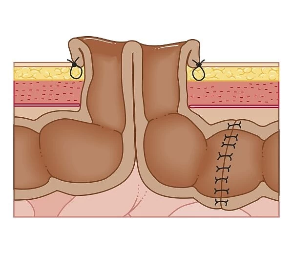 Cross section biomedical illustration of temporary colostomy