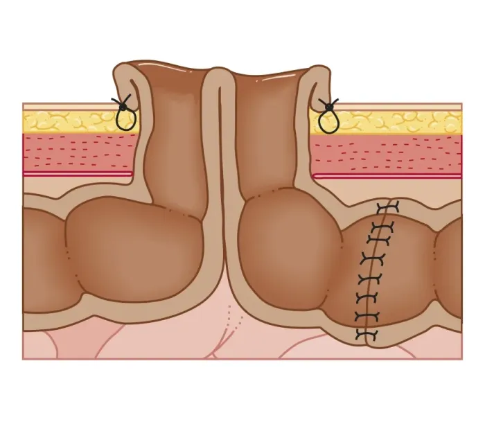 Framed Print : Cross section biomedical illustration of temporary colostomy Framed Print : Cross section biomedical illustration of temporary colostomy