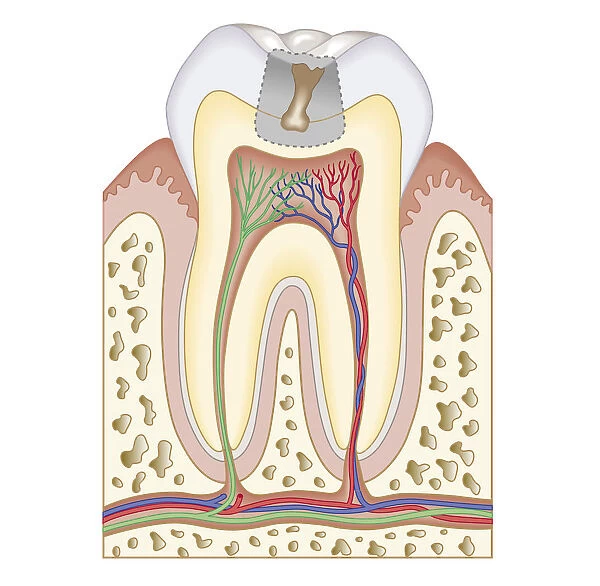 Cross section biomedical illustration of tooth decay before dental filling