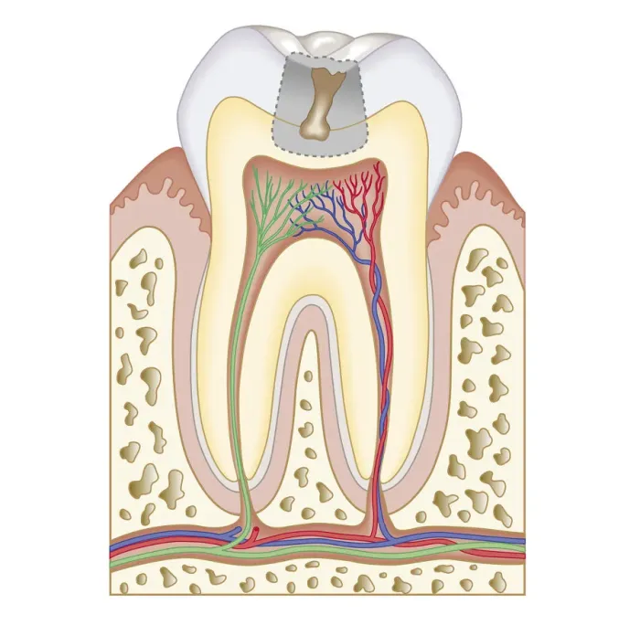 Framed Print : Cross section biomedical illustration of tooth decay before dental filling Framed Print : Cross section biomedical illustration of tooth decay before dental filling