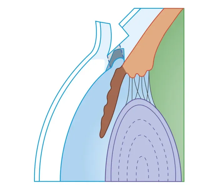 Framed Print : Cross section biomedical illustration of Trabeculectomy, surgical technique used to treat chronic glaucoma Framed Print : Cross section biomedical illustration of Trabeculectomy, surgical technique used to treat chronic glaucoma