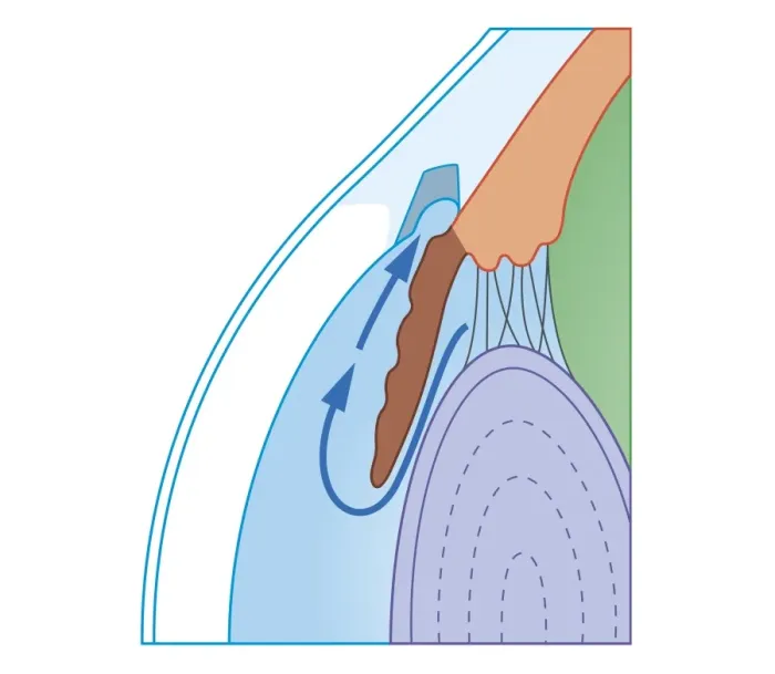 Framed Print : Cross section biomedical illustration of Trabeculectomy procedure to treat glaucoma by relieving Intraocular pressure Framed Print : Cross section biomedical illustration of Trabeculectomy procedure to treat glaucoma by relieving Intraocular pressure