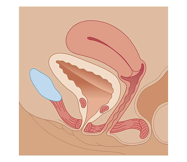 Cross section biomedical illustration of urinary incontinence in female