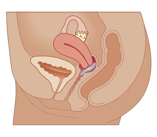 Cross section biomedical illustration of vaginal ring in position