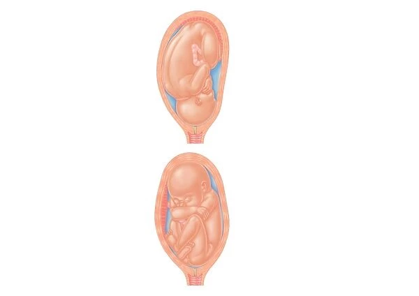 Cross section digital illustration of foetus in normal position and foetus in complete breech position with buttocks presented first