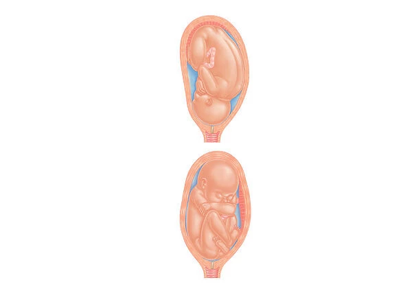 Cross section digital illustration of foetus in normal position and breech position