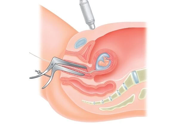 Cross section digital illustration showing speculum inserted into vagina during medical examination