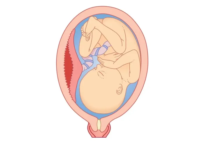 Framed Print : Cross section digital illustration showing abruption where placental lining has separated from uterus of mother Framed Print : Cross section digital illustration showing abruption where placental lining has separated from uterus of mother