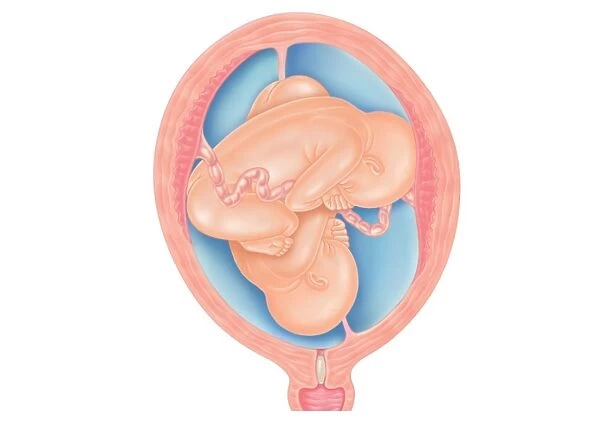 Cross section digital illustration of twins showing normal foetal presentation and transverse lie