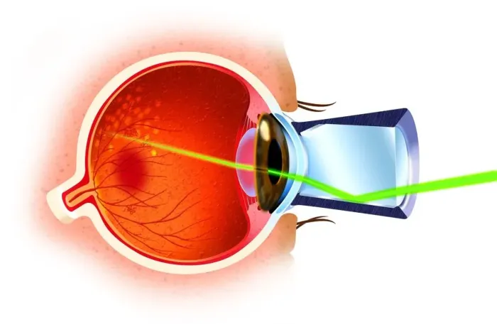 Framed Print : Cross section of eye ball, laser ray entering through pupil, directed at eye nerves Framed Print : Cross section of eye ball, laser ray entering through pupil, directed at eye nerves