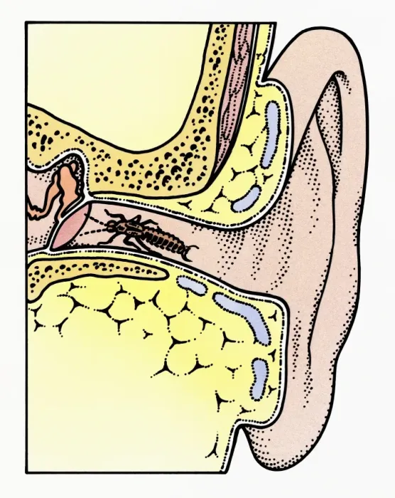 Framed Print : Cross section illustration of Common Earwig (Forficula auricularia) in auditory canal of ear, touching tympanic membrane with antennae Framed Print : Cross section illustration of Common Earwig (Forficula auricularia) in auditory canal of ear, touching tympanic membrane with antennae