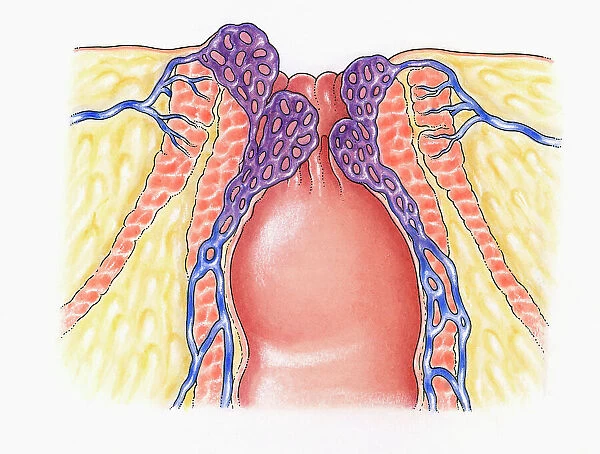 Cross section illustration of human anal column showing external and internal sphincters, healthy veins, and internal and external haemorrhoids causing inflammation of rectum and anus veins