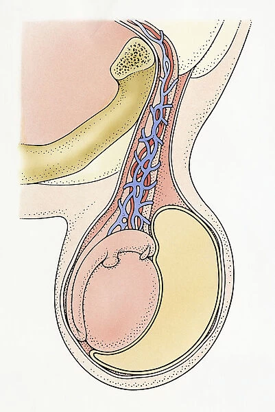 Cross section Illustration showing infantile hydrocele testis, with clear, amber-coloured fluid from spermatic cord surrounding testicle, resulting in swelling