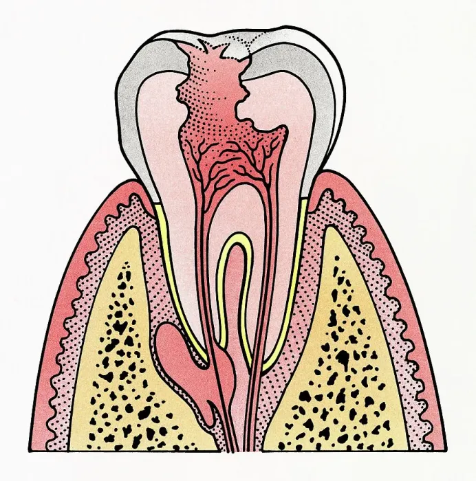 Framed Print : Cross section illustration showing tooth decay Framed Print : Cross section illustration showing tooth decay