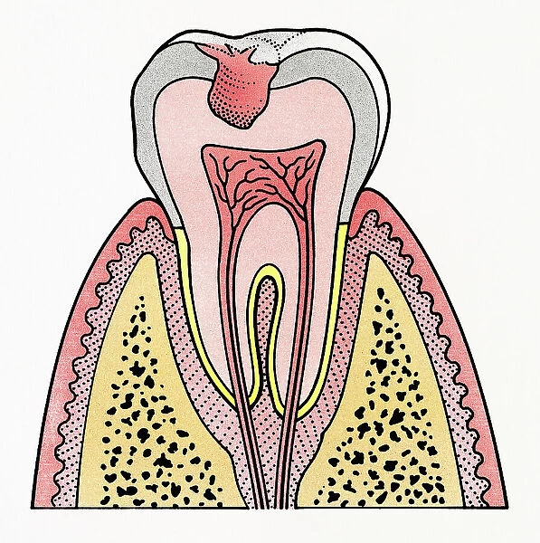 Cross section illustration showing tooth decay