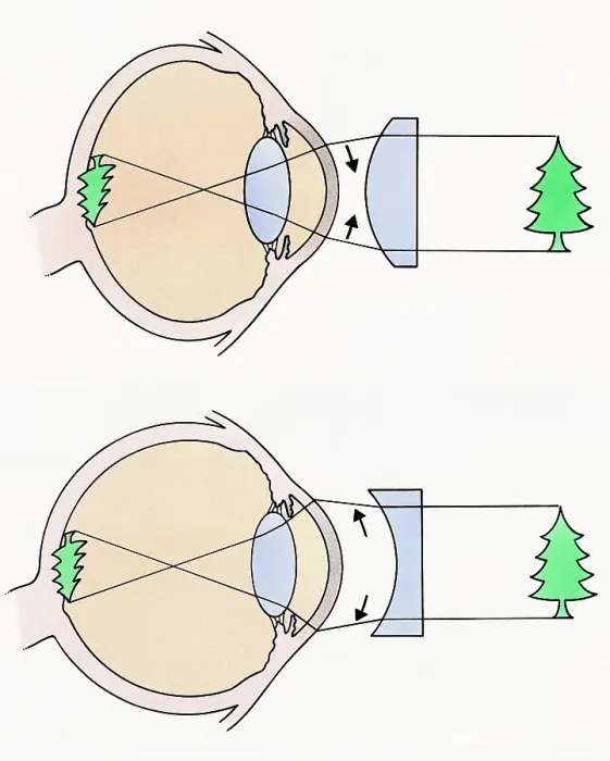 Framed Print : Cross section illustrations of human eyes with concave and concave lenses looking at green tree Framed Print : Cross section illustrations of human eyes with concave and concave lenses looking at green tree