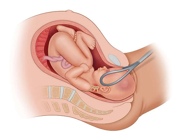 Cross section of the mothers anatomy showing the baby OP in uteruo being delivered by