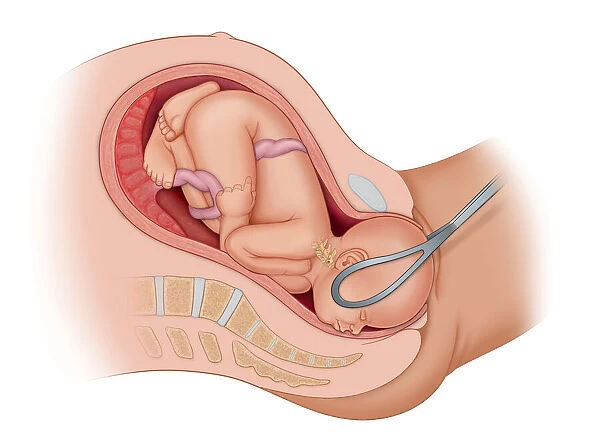 Cross section of the mothers anatomy showing the baby in uteruo LOA being delivered