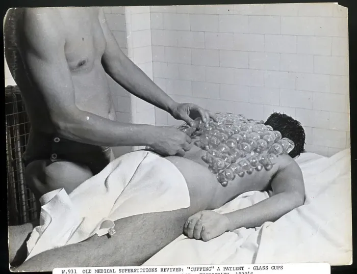 Framed Print : Cupping Patient During 1920S Revival Framed Print : Cupping Patient During 1920S Revival
