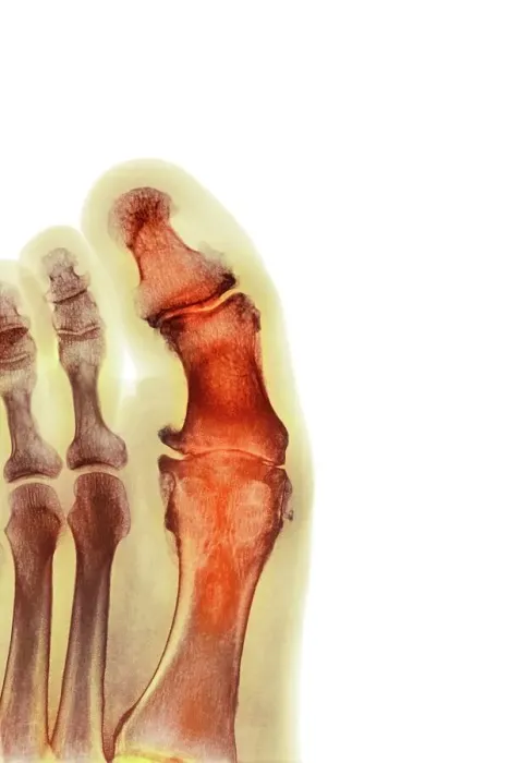 Framed Print : Degenerative foot deformation, X-ray Framed Print : Degenerative foot deformation, X-ray